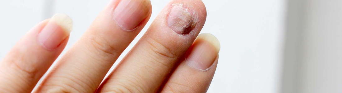 QUE FAIRE EN CAS DE MYCOSE DES ONGLES ?